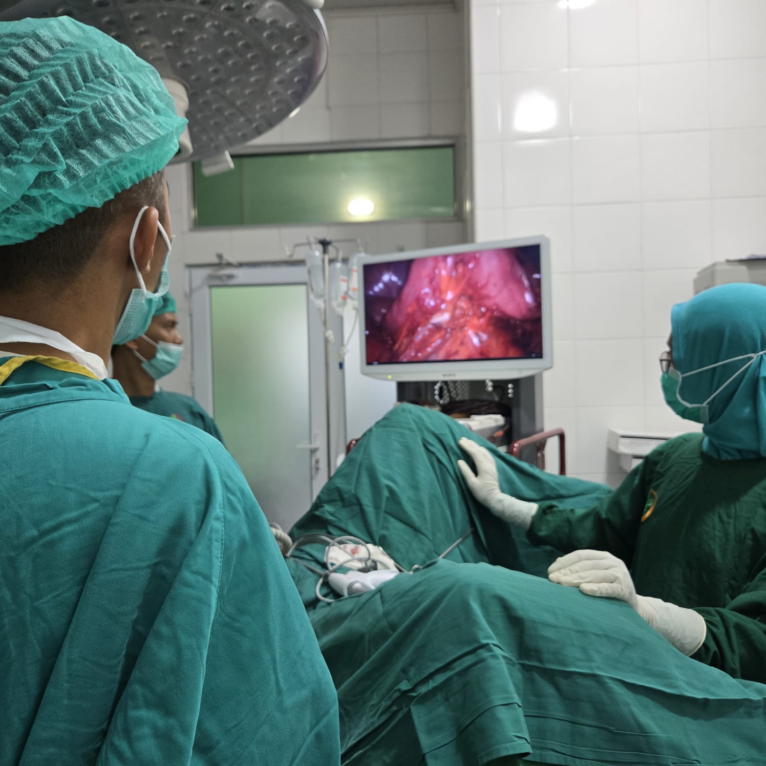 SILS (Single Incision)