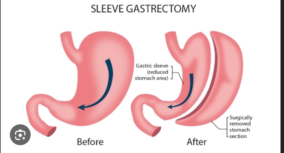 Gastric Bypass