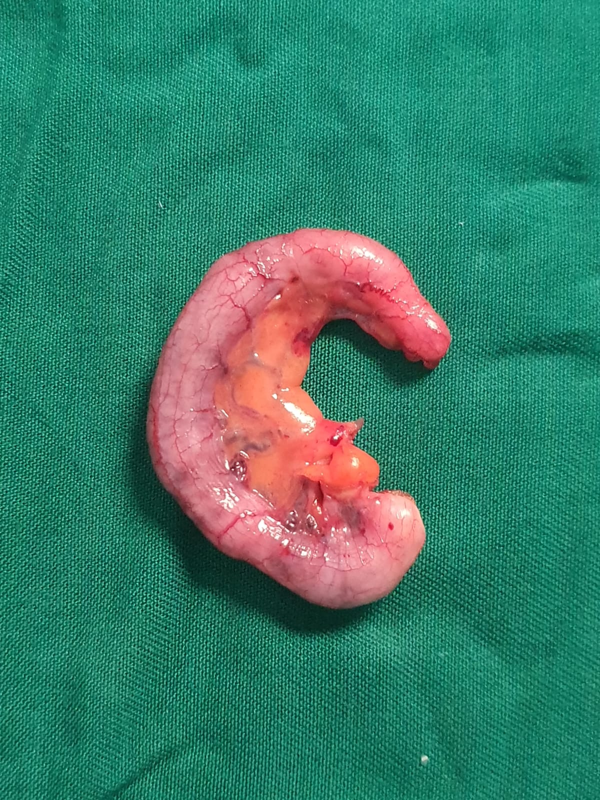 Monitor Laparoskopi